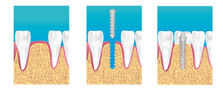 implant dentaire Pantin